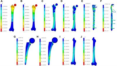 Biomechanics of PHILOS plates in Vancouver B1 periprosthetic femoral fracture